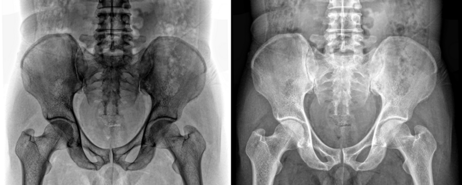 Pelvis Anterior View X-Ray Showing Hip and Pelvic Bone Anatomy for Pain Evaluation and Diagnosis Isolated on a Transparent or White Background