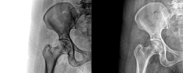 Hip Joint Anterior View X-Ray Showing Pelvic and Femoral Anatomy for Diagnosis and Preservation...