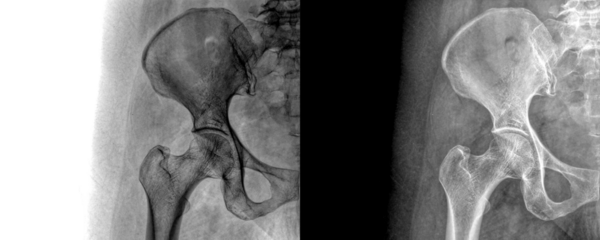 Hip Joint Anterior View X-Ray Showing Pelvic and Femoral Anatomy for Diagnosis and Preservation Surgery Planning Isolated on a Transparent Background