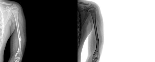 Medical X-Ray of Arm in Anterior View Showing Skeletal Structure and Muscle Outline for Diagnosis...