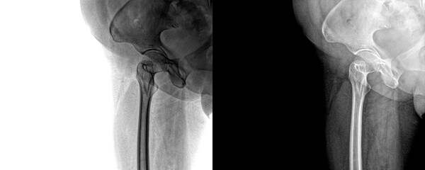 Hip Joint Lateral View X-Ray Showing Pelvic and Femoral Alignment for Diagnosis, Fracture...