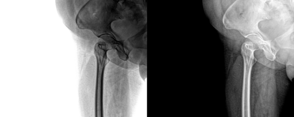 Hip Joint Lateral View X-Ray Showing Pelvic and Femoral Alignment for Diagnosis, Fracture Evaluation, and Hip Replacement Planning Isolated on a Transparent or White Background