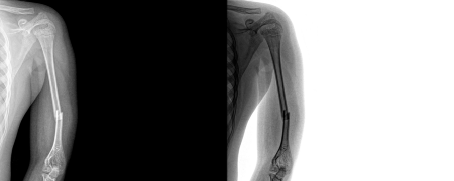 Medical X-Ray of Arm in Anterior View Showing Skeletal Structure and Muscle Outline for Diagnosis of Fractures and Orthopedic Evaluation Isolated on Transparent or White Background - Powered by Adobe