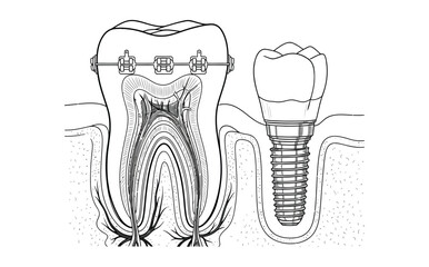 Diagram illustrating a tooth with braces and a dental implant in the jawbone.