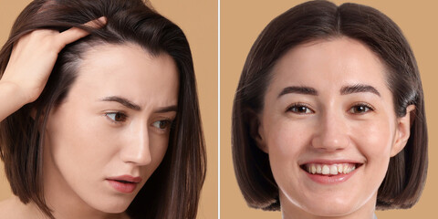 Woman with hair loss problem before and after therapy, closeup. Collage on beige background