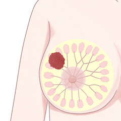 Blank Breast cancer Stage 3 diagram Human anatomy PNG