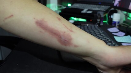 A man who feels angry because of itchy skin which causes red irritation on his hands