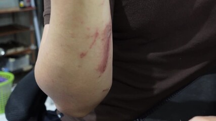 A man who feels angry because of itchy skin which causes red irritation on his hands