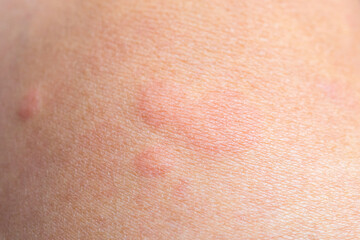 Skin allergy rash dermatitis texture close up background