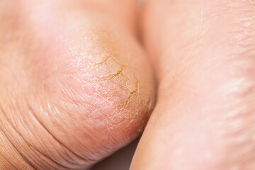 Cracked skin condition treatment home remedies healthcare tips indoor close-up skin care