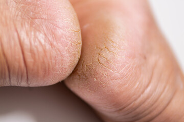 Dry and cracked skin condition close-up health awareness indoor detailed view