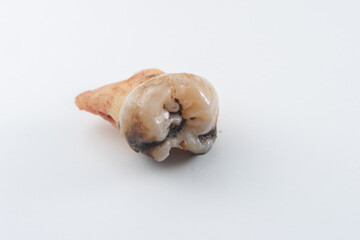 Extracted decayed tooth with filling on gauze
