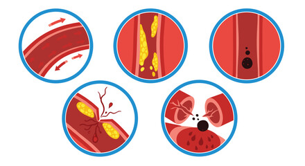 Illustration depicting stages of blood vessel blockage: normal blood flow, cholesterol buildup, clotting, rupture, and complete blockage.