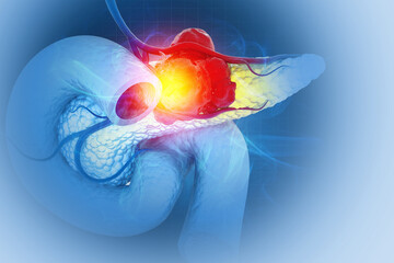 Pancreatic cancer is cancer that forms in the cells of the pancreas. 3d illustration