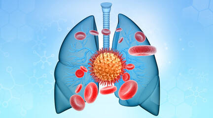 Human lungs virus bacterial infection. 3d illustration