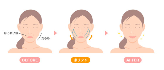 糸リフトの施術内容と効果 ベクターイラスト