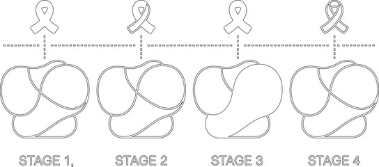 Black and White Outline of Cancer Stages with Ribbons Above Each Stage Shown