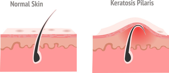 Keratosis pilaris. Hair structure, anatomy. Hair grows back into the skin instead of rising to the surface. Skin part diagram. Vector  illustration