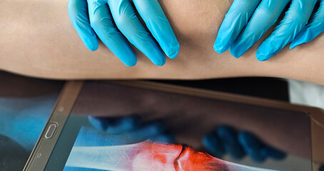 Traumatologist examines X-ray of little girl leg