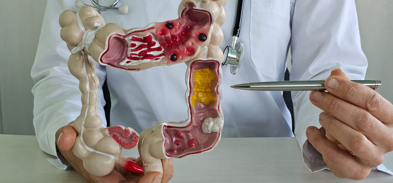 Intestine doctor holding an anatomical model for diagnosis and treatment in hospital