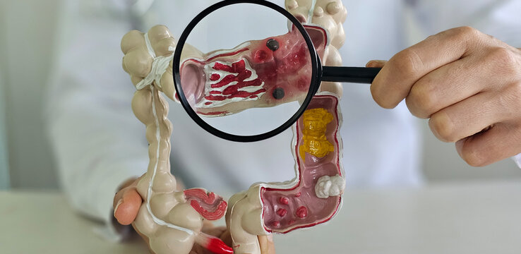 Magnifying glass and colon diseases and colorectal cancer and ulcerative colitis