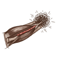 Detailed anatomical illustration of a human arm with muscles and bones, depicting a nerve ending in a chaotic, painful neurological condition.