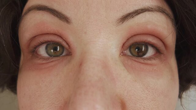 Caucasian woman showing her swollen eyes with red allergic reaction. Eczema or peeling psoriasis on face skin. Inflamed dry eyelid skin, dermatological disease. Beautiful female iris hetero chromia.