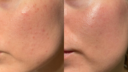 Close-up comparison showing before and after skincare results. Visible skin improvement, smoother...