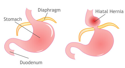 Hiatal hernias and acid reflux. Condition where a small part of the stomach swells through an opening in the stomach.. Vector illustration