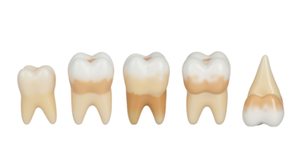 Human tooth anatomy model demonstrating the dental staining and plaque formation