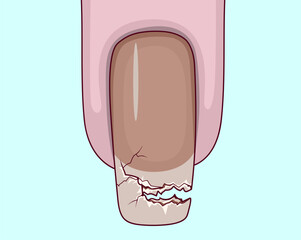 Broken nail. Healthcare illustration. Vector illustration.