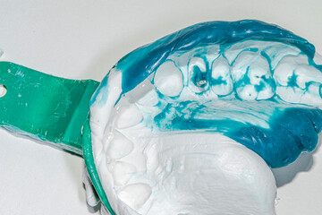 Maxillary dental arch impression using a double mixture of heavy white silicone and relined light blue material, showing a premolar with a metallic root post prepared for a post and core restoration. © MSC