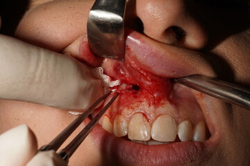 Dental Surgery, Extraction Of A Tooth, Dental Procedure, Oral Surgery, Doctor Removing A Tooth, Human Teeth, Surgical Operation, Medical Procedure, Healthcare Concept