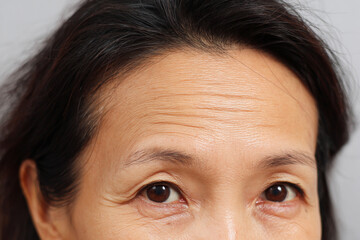 Closeup of an Asian woman's forehead showing wrinkles and aging signs