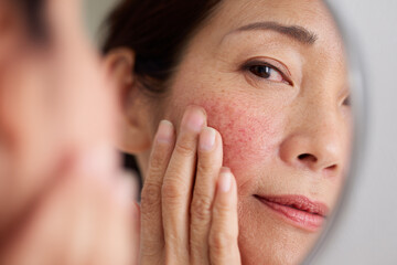 Asian woman with rosacea touching her face while looking in the mirror