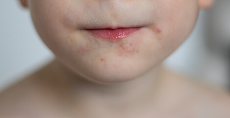 Boys face with red rash infection around his mouth, blurred background 