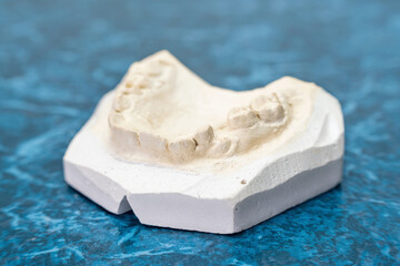 Dental plaster cast on a blue background in a dental laboratory