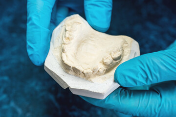 The dentist's hands hold a plaster cast of the upper jaw teeth
