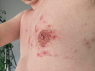 Fototapeta premium An adult's chest is shown with numerous red, inflamed bumps and pustules.