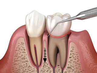 Periodontal probing shows gum recession isolated on transparent background