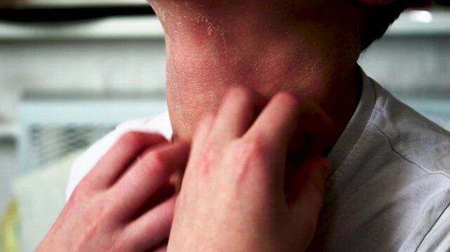 Symptoms of atopic dermatitis on a red neck with itching and dry skin. Allergy on neck skin.