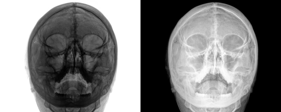 Pns Posteroanterior View X-Ray Radiograph Showing Paranasal Sinus Anatomy for Better Visualization of Frontal Sinuses, Surgical Planning, and Diagnosis Isolated on a Transparent