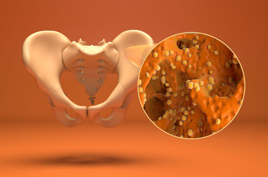 Bone tumor (cancer)  - isometric view 3d illustration