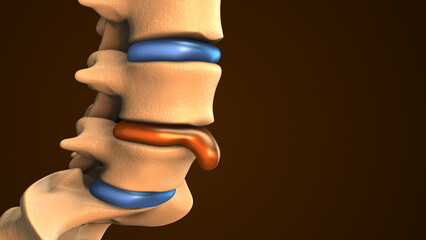 Spinal Disc Herniation Shown in Medical Animation