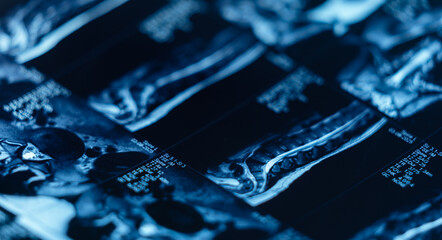 Mri scan of spine revealing disc protrusion and detailed vertebral structure