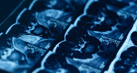 Mri scan showing lumbar spine with disc protrusion