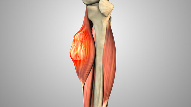 Malignant Soft Tissue Sarcoma in Leg