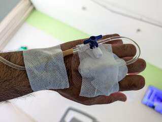  intravenous (IV) Catheter Inserted in Patient's Hand at Hospital