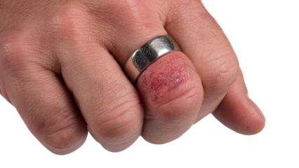 PNG of Close-up of a male hand with a silver ring showing irritated skin around the finger, highlighting signs of dermatitis.