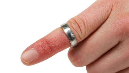 PNG of A close-up of a male hand with a silver ring on a red, irritated fingertip.